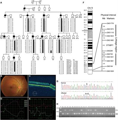 p.His16Arg of STXBP1 (MUNC18-1) Associated With Syntaxin 3B Causes Autosomal Dominant Congenital Nystagmus